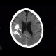 Oligodendroglioma of parietal lobe: CT - Computed tomography